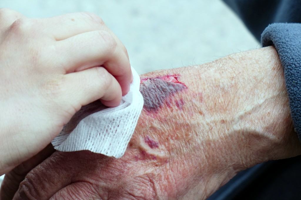 Eucalyptus essential oil uses wounds