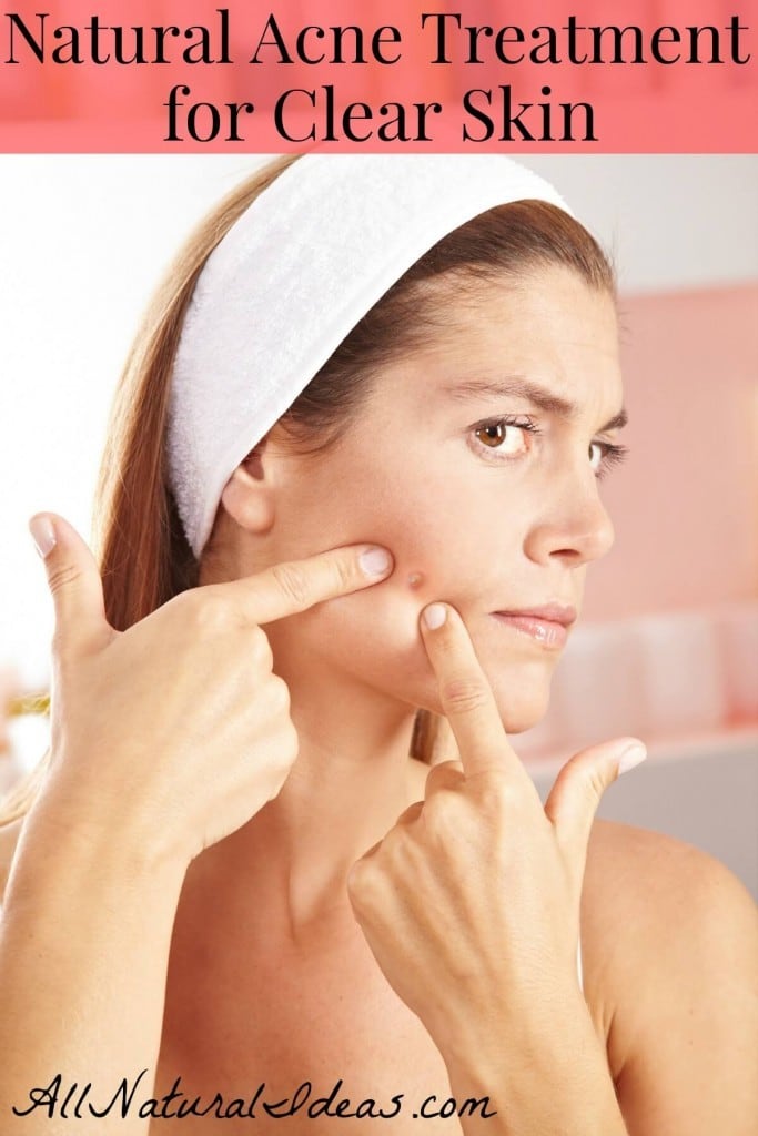Do you have persistent acne that just won't go away? Have you tried creams and products to eliminate acne? Try natural acne treatment for clear skin.