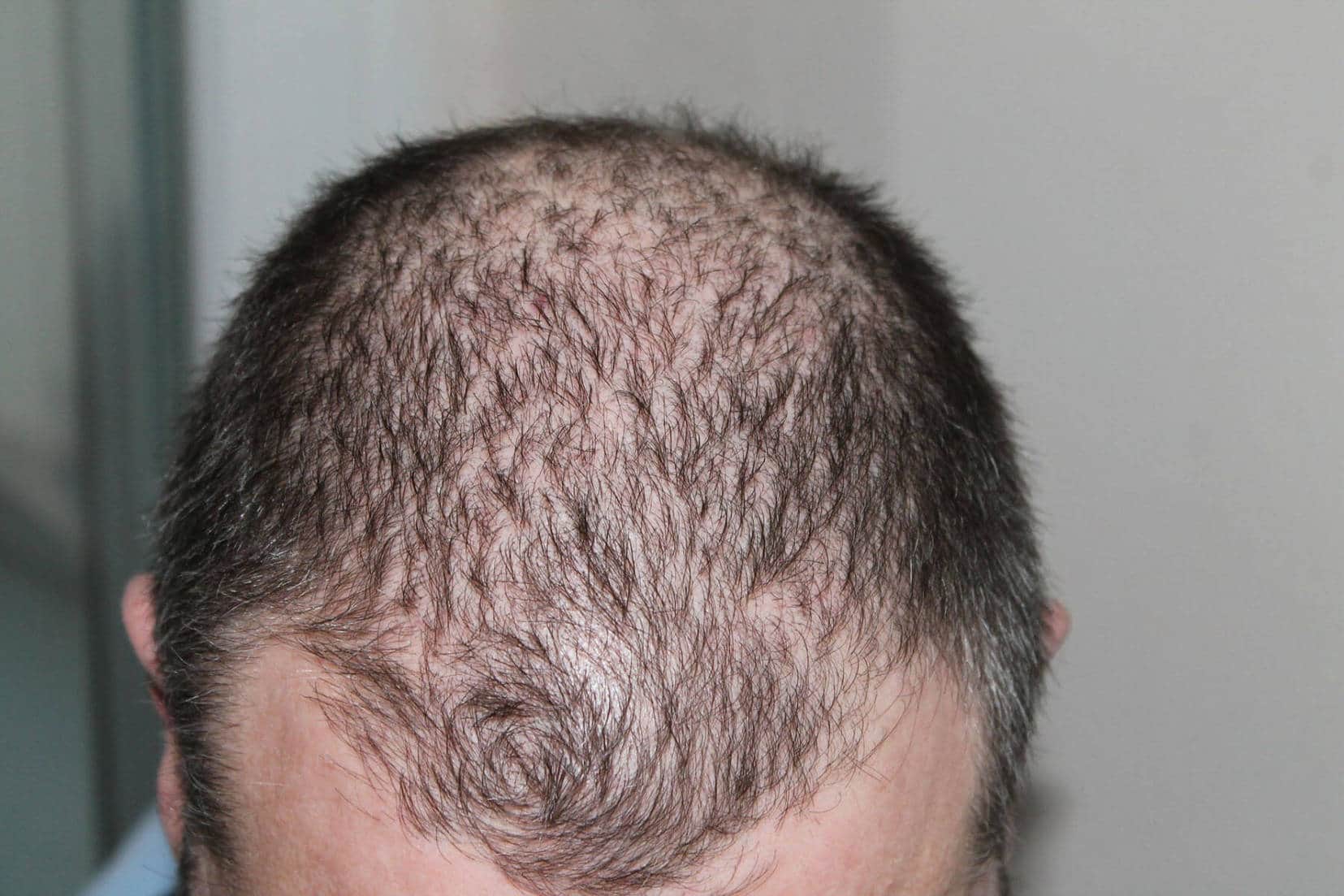 Stop or reduce hair loss naturally