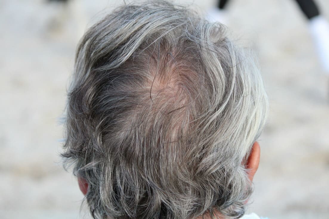 Gray hair pill? Natural remedies for gray hair.