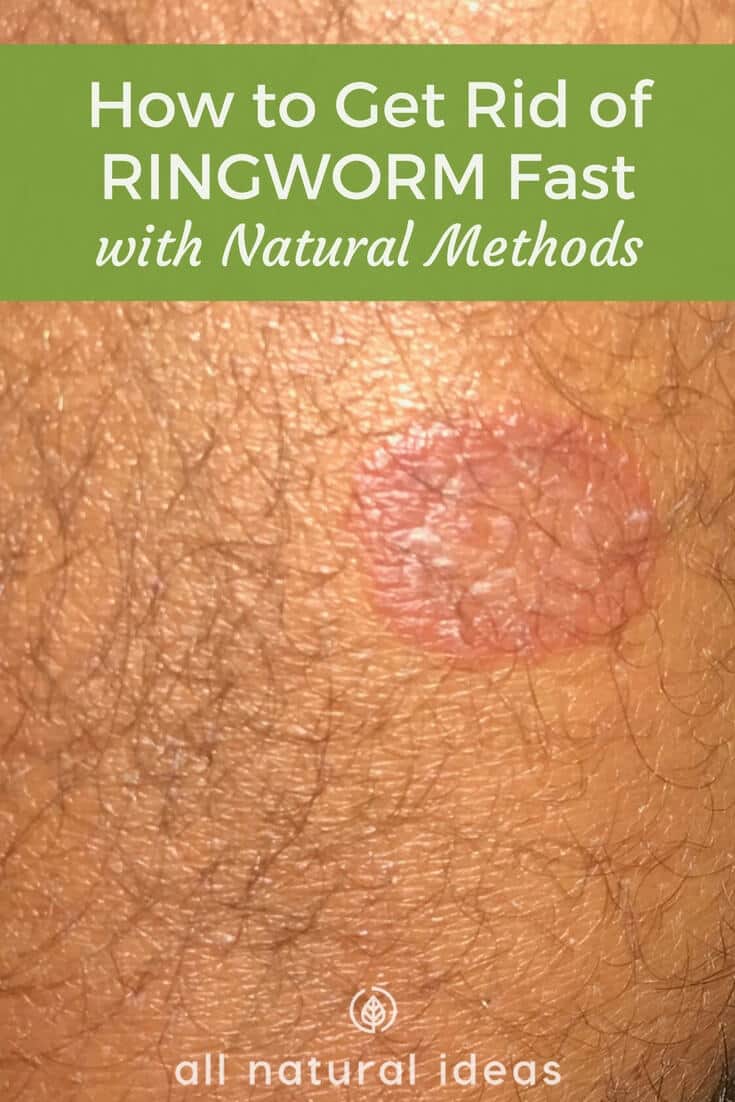 How to get rid of ringworm fast naturally