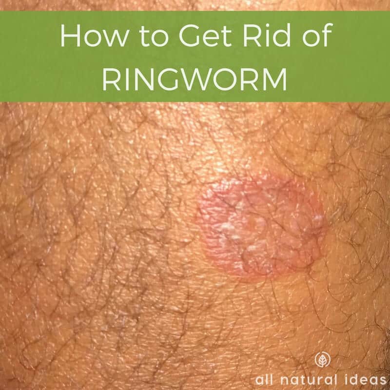 How to get rid of ringworm fast