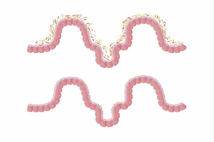 Do you need a leaky gut syndrome test?