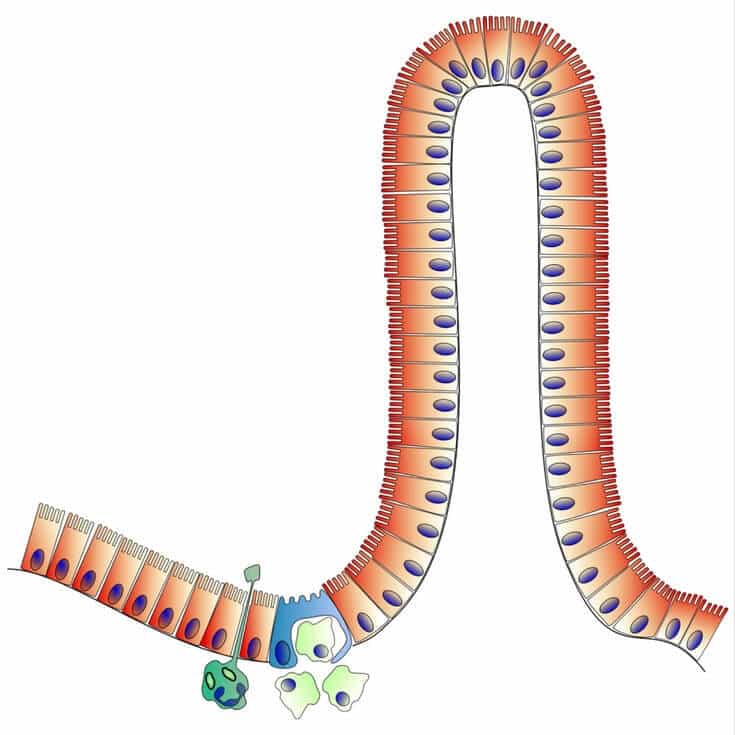 What is a leaky gut syndrome test?