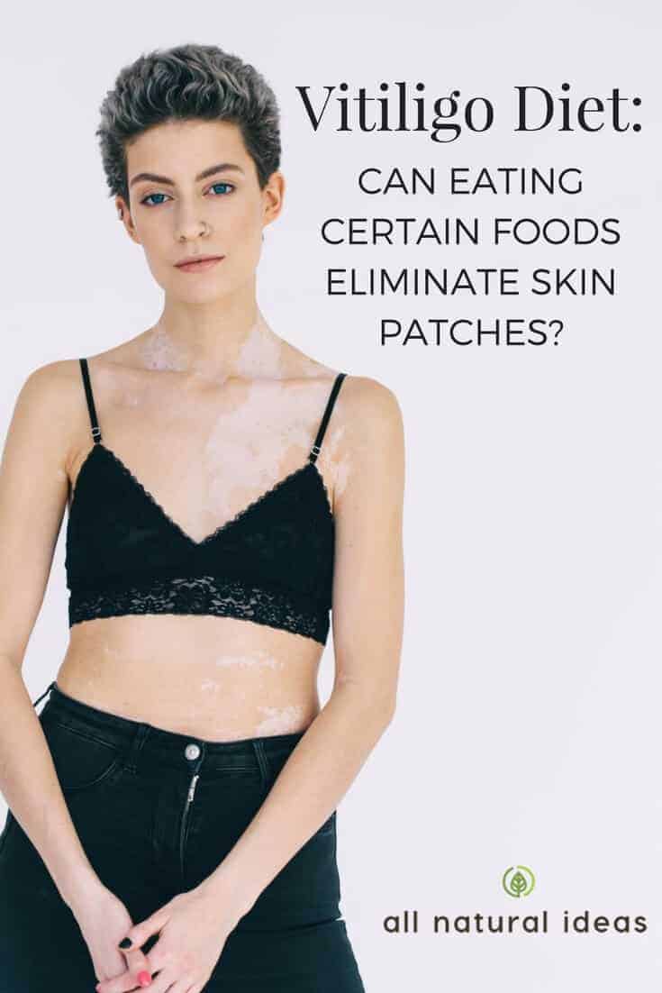Vitiligo diet may reduce or even eliminate blotchy, white patches. But certain foods, even ones that are considered healthy have to be avoided.