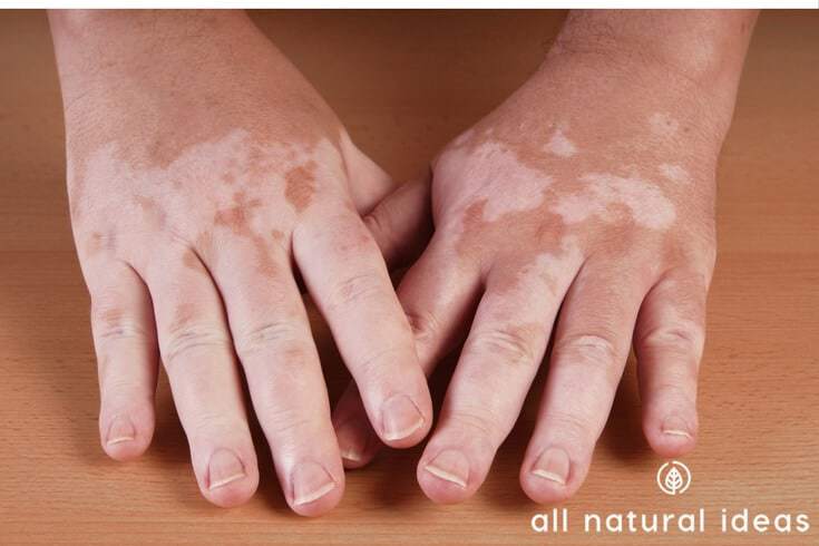 Vitiligo diet may reduce or even eliminate blotchy, white patches. But certain foods, even ones that are considered healthy have to be avoided.
