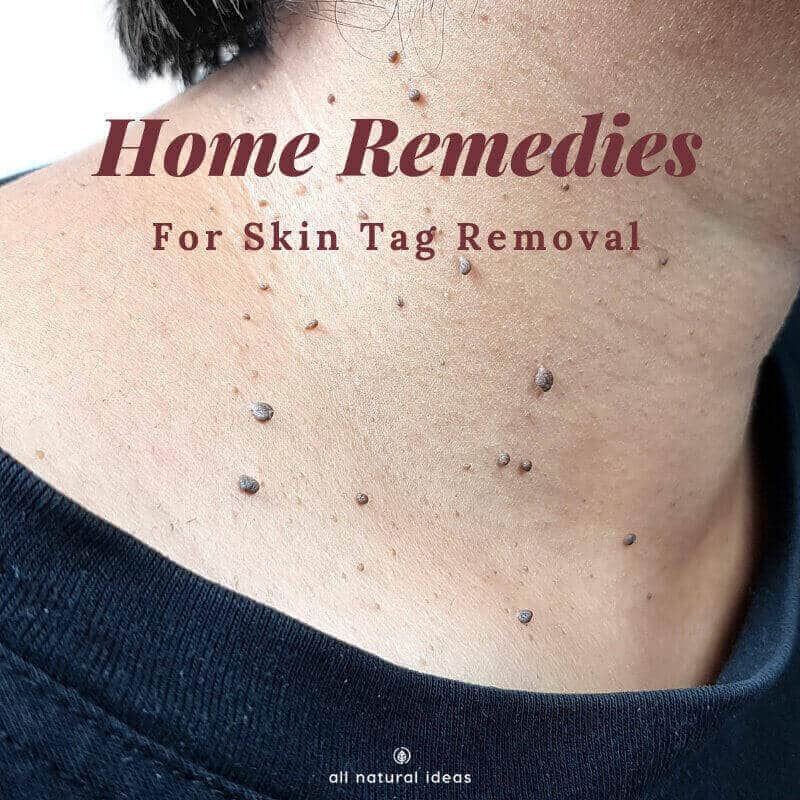 They might not be a serious medical issue, but they're unsightly. If you've got them, here are some home remedies for skin tags removal.